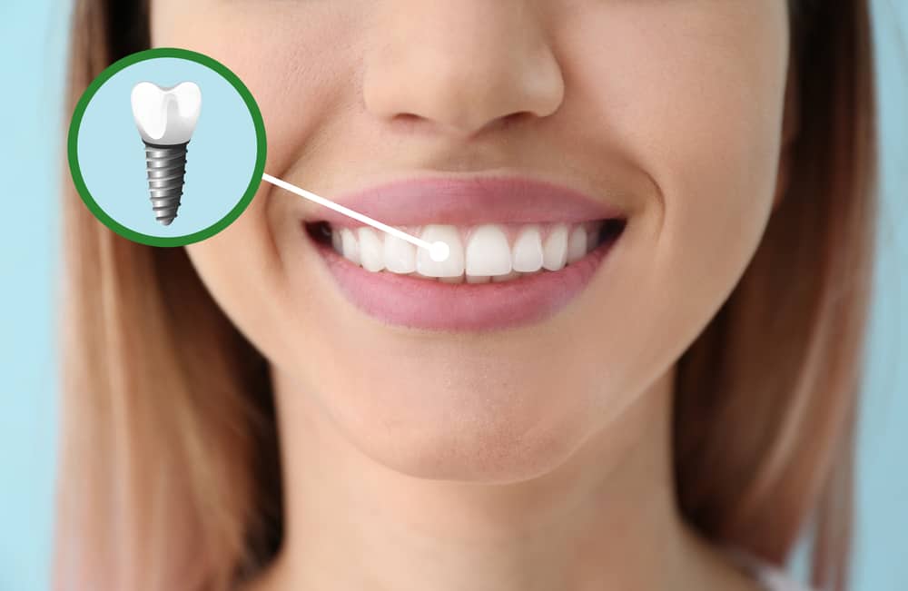 Tips for Taking Care of a Dental Implant