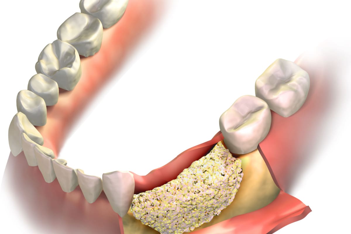 Dental Bone Grafting: Things You Should Know