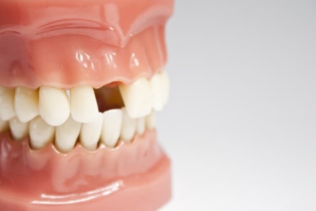 What Happens If You Ignore a Missing Tooth?