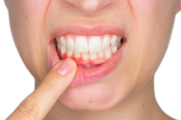 5 Things Everyone Should Know about Gum Disease