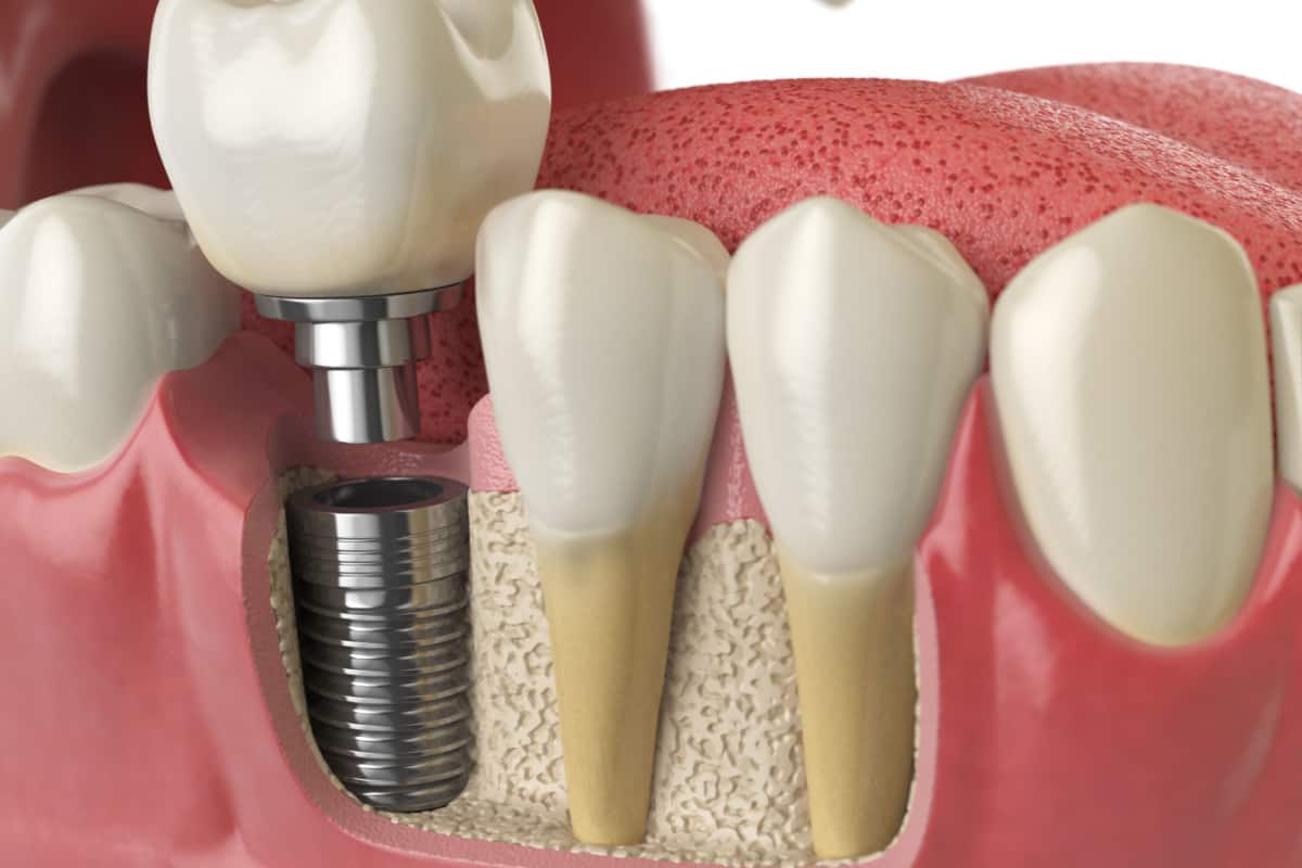 What Causes Issues with Dental Implants?