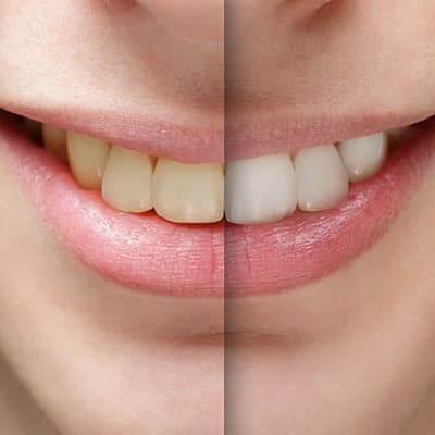 Whitening: 5 Things to Know Before Getting a Brighter Smile