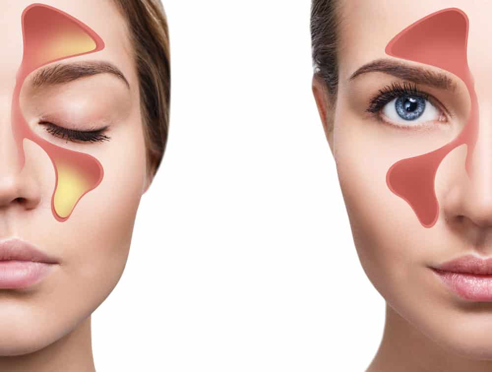 Understanding Sinus Augmentation Surgery: Why and When It’s Needed for Implants